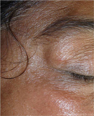 Multipolar-RF-Before